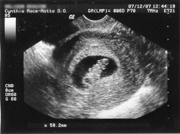 Sonogram+9+weeks.jpg